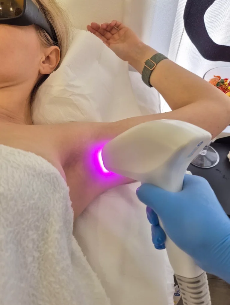 Koliko je sigurna laserska epilacija?