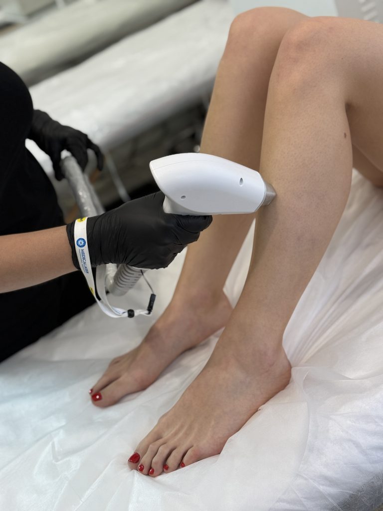 6 stvari koje trebate znati prije nego što krenete na lasersku epilaciju!